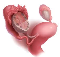 SOP: Muito Além dos Ovários – Um Guia Integrativo para o Equilíbrio Hormonal